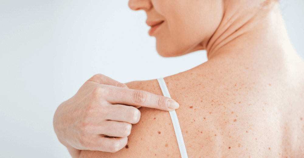 Mélanome : une onco-dermatologue répond à vos questions