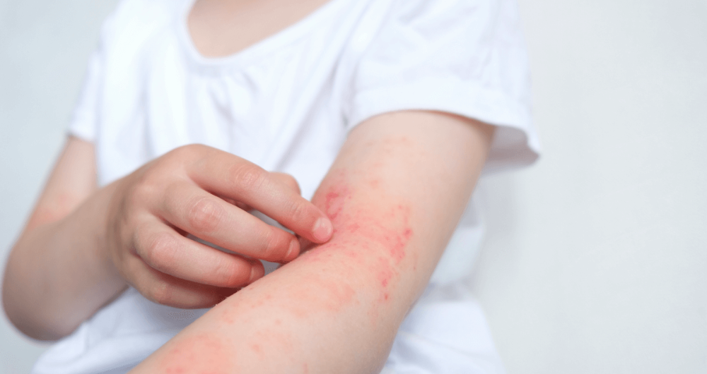 Tout savoir sur les allergies cutanes